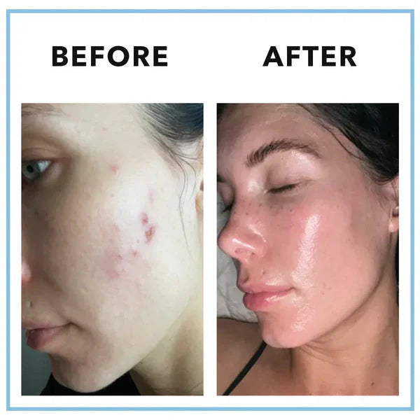 Vitamin Supplement – Hormonal Acne & Skin Balance Formula – 90 Capsules