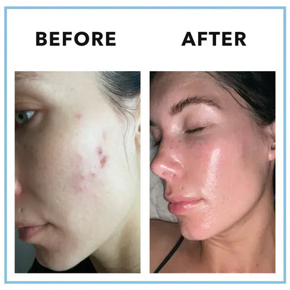 Vitamin Supplement – Hormonal Acne & Skin Balance Formula – 90 Capsules